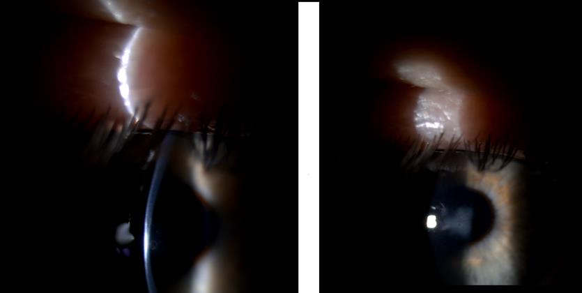 Οφθαλμός με κερατόκωνο. Αριστερά: χαρακτηριστική λέπτυνση του στρώματος, δεξιά: κεντρική ουλοποίηση