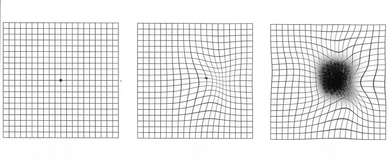 foto from the amsler test: the left one is the regular one. The central is its appearance with metamorphopsia symptoms. The right one is its appearance with  metamorphopsia symptoms and central blurring.