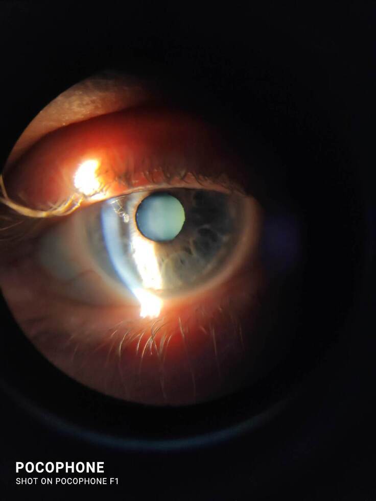 Pseudoexfoliation syndrome: a big eye trouble