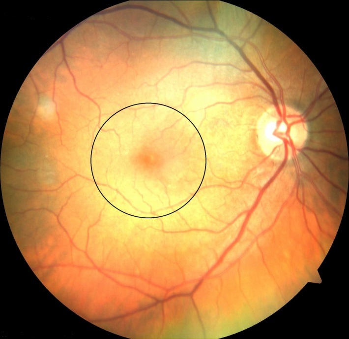 photo vom hinteren Pol eines gesunden Auges. Innerhalb des Kreises befindet sich die Makula.