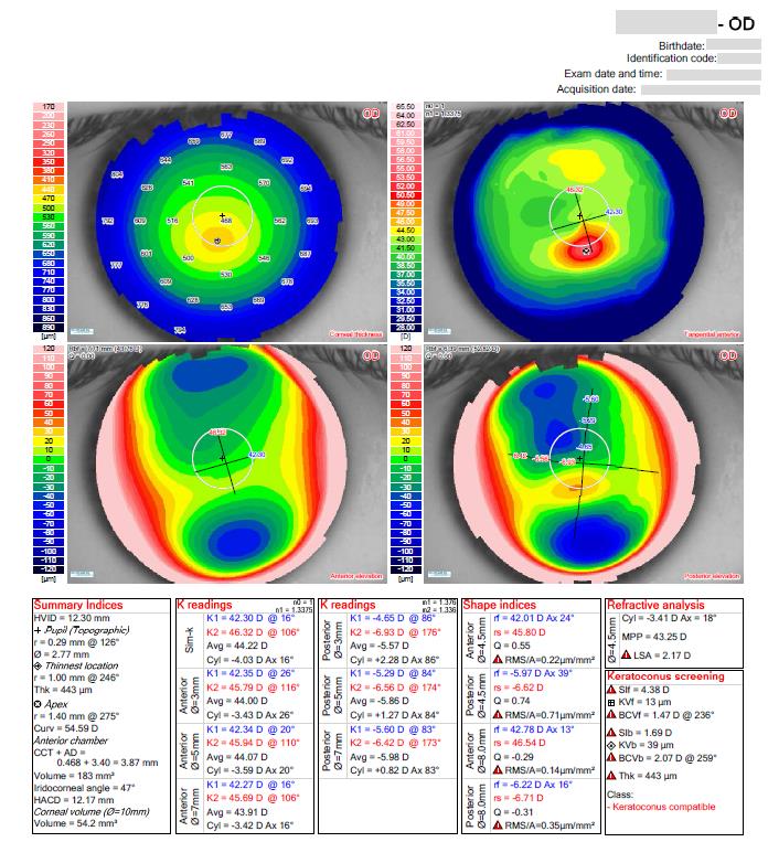 Keratoconus on the topography report.