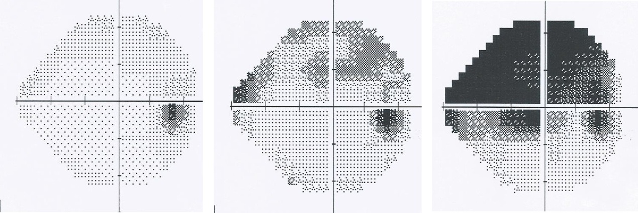 On this photo we can observe the progression of the glaucoma of one patient over the time, through the visual field examination.