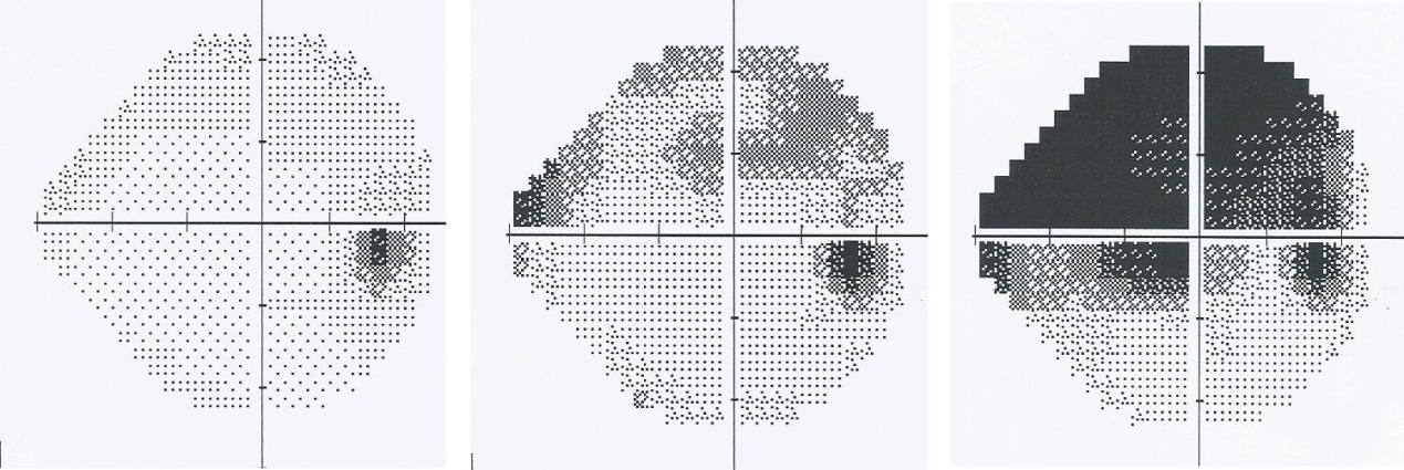 On this photo we can observe the progression of the glaucoma of one patient over the time, through the visual field examination.