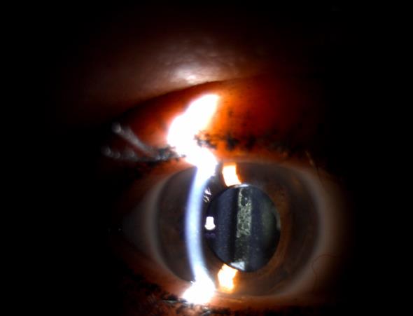 PCO on the slit lamp