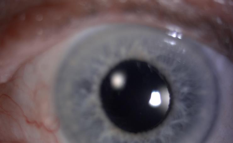 eye with  with an artificial intraocular lens after the cataract operation