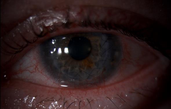 Eye after a corneal transplantation