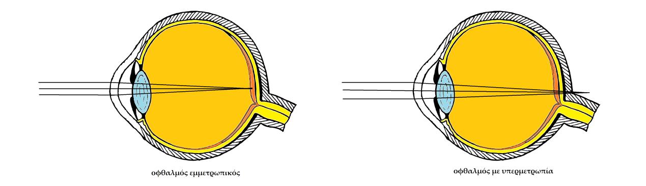 παράδειγμα με οφαλμό εμμετρωπικό και οφθαλμό με υπερμετρωπία