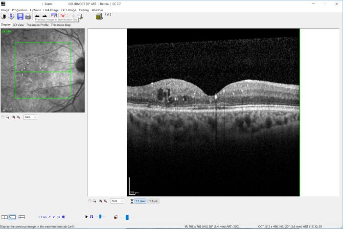 the OCT of a macula with diabetic macular oedema