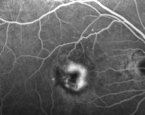 Photo von einer Fluoreszenzangiographie bei einem Patienten mit feuchten AMD. Er benötigt intravitreale Injektionen.