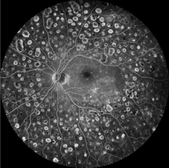 Εικόνα φλουοροαγγειογραφίας αμφιβληστροειδούς μετά από argon φωτοπηξία