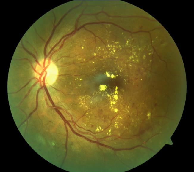 non proliferative Retinopathia diabetika mit Blutungen und Fettablagerungen