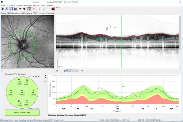 normal OCT of a healthy optic nerve