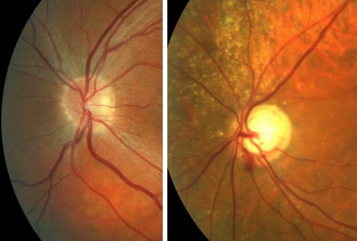 This is the head of the the optic nerve. On the left photo it is healthy one. The right one is of a glaucoma patient, it has a big excavation and a hemorrhage at 7 o clock. 