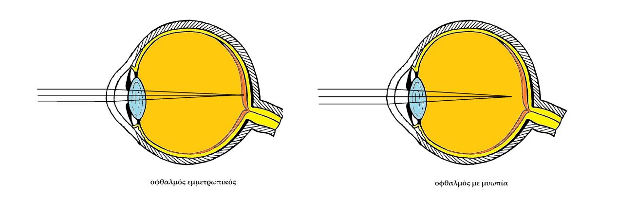 παράδειγμα με οφαλμό εμμετρωπικό και οφθαλμό με μυωπία