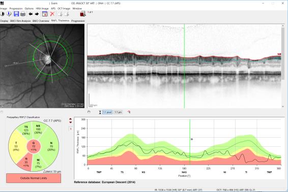 a glaucoma patient, with a typical RNFL thinning on the temporal-down area