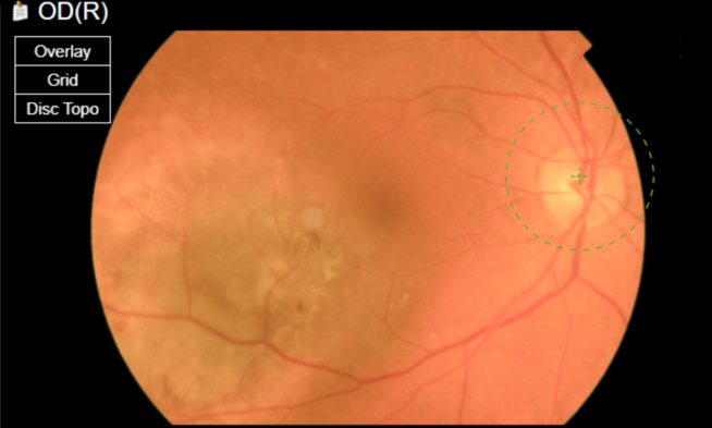 Chorioidal melanoma, the most usual malignancy in the eye