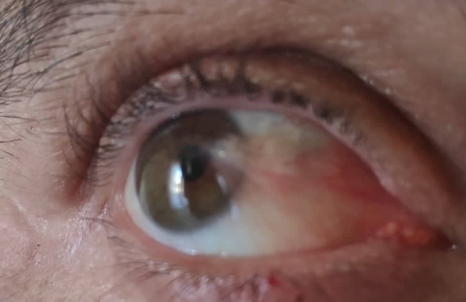 What is the pterygium of the eye?