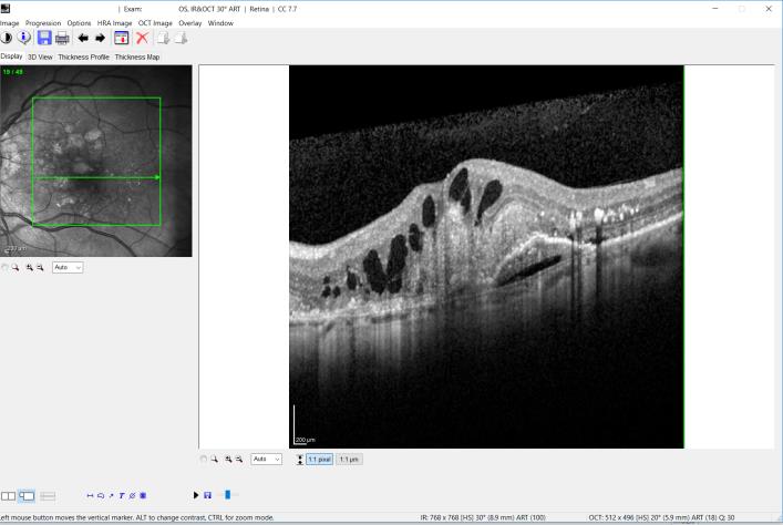 Photo von der Makula OCT eines Patienten mit feuchter AMD