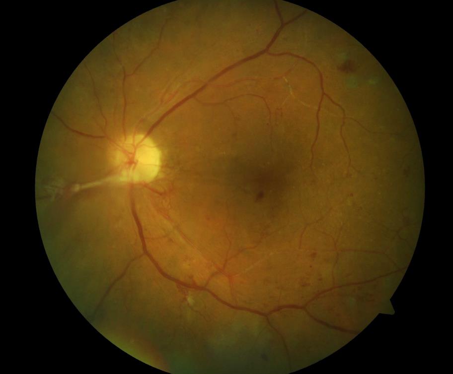 proliferative diabetische Retinopathie mit neuen Gefäßen an der Papille